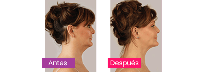 My Face Lift