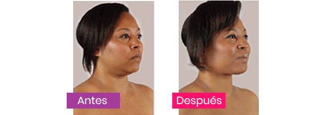 My Face Lift