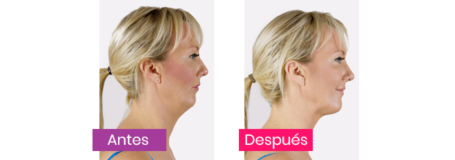 My Face Lift