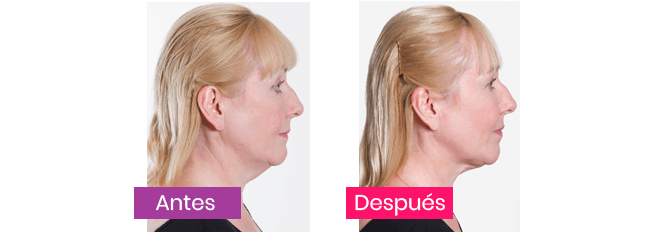 My Face Lift